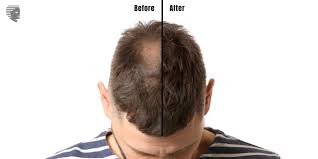  Non-Surgical Hair Replacement