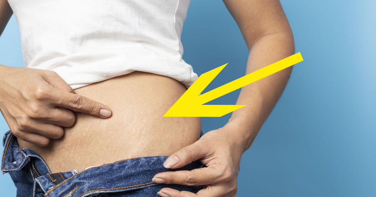 Fade Stretch Marks