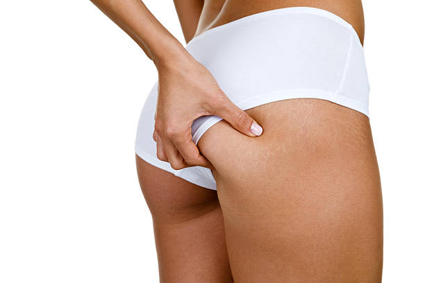 How Long Does Stretch Mark Removal Takei