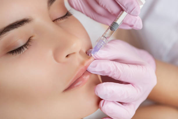 How Often Should You Get Lip Fillers