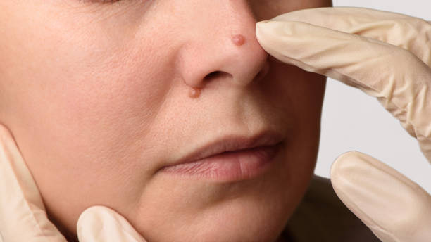 Is Warts Removal Good for All Skin