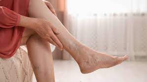 Quick vein treatment