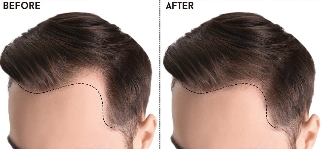 Revitalizing Locks: A Comprehensive Guide to Hair Transplants in Pakistan