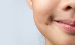 How Do I Choose the Right Surgeon for Dimples?