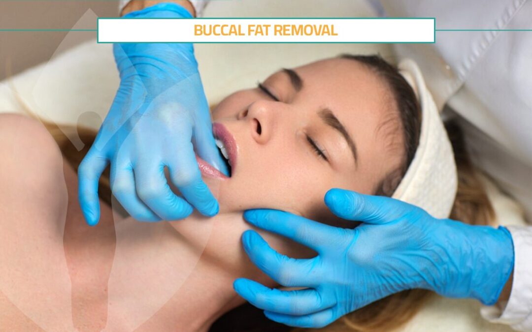 Buccal Fat Removal for Elegant, Sharp Cheekbones