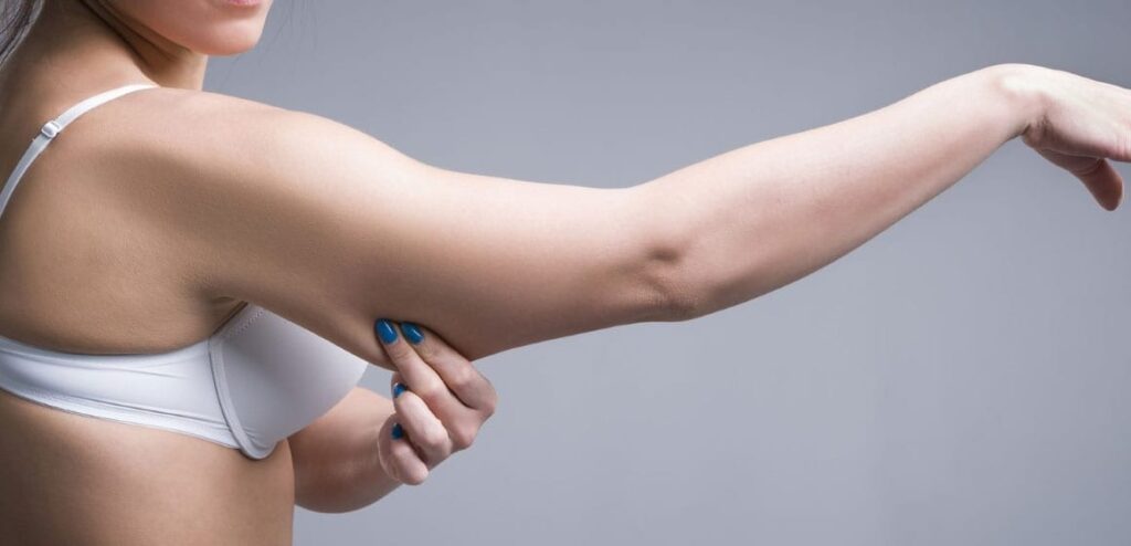 Can Brachioplasty Help After Weight Loss