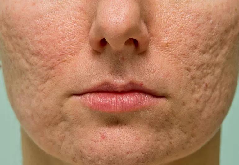 Which Skin Care Routine Helps Prevent Acne Scars?