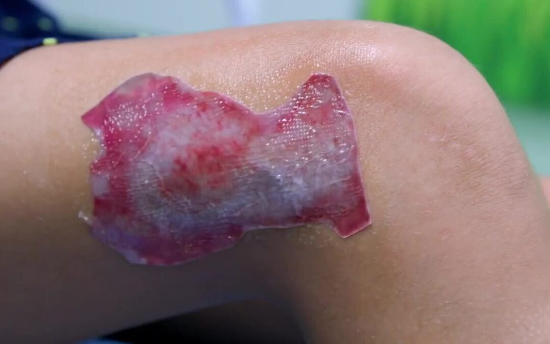 Common procedures in reconstructive burn surgery