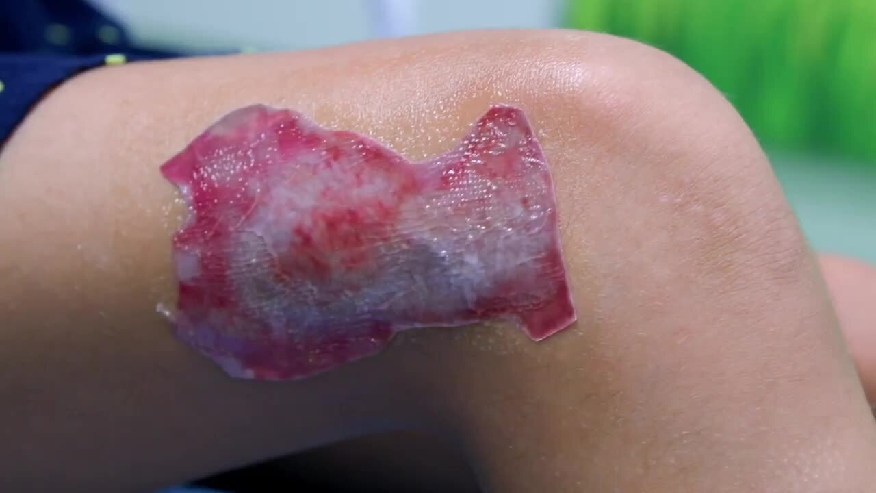 Common procedures in reconstructive burn surgery