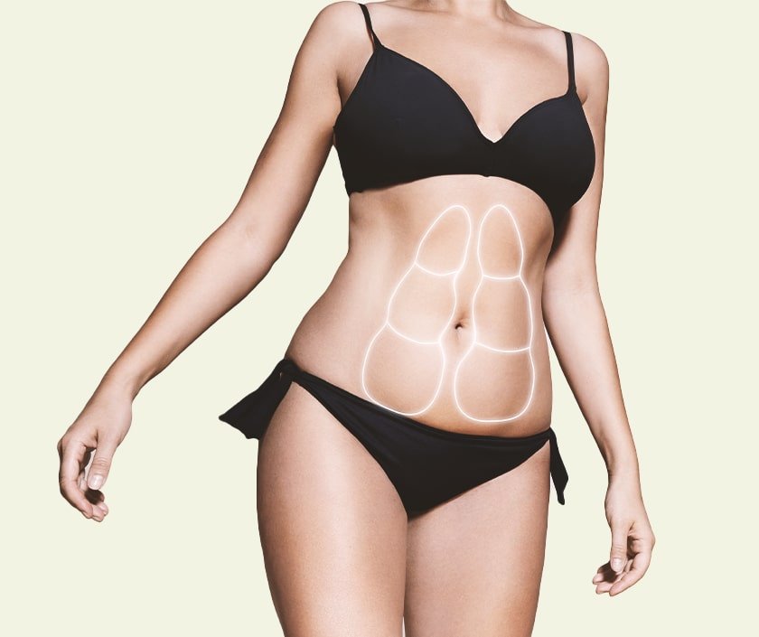 Does Fat Come Back After Liposuction Truth Revealed