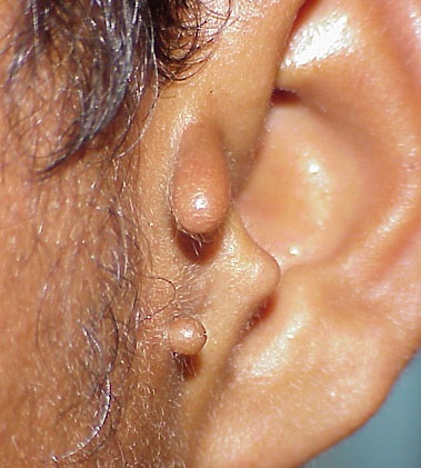 How Effective Is Preauricular  Tag Removal