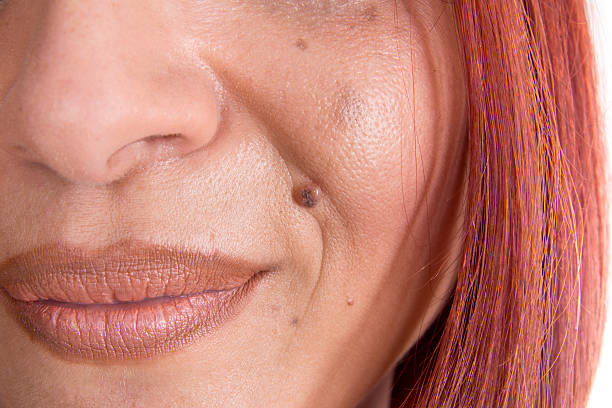 How Effective Is Skin Tag Removal ?