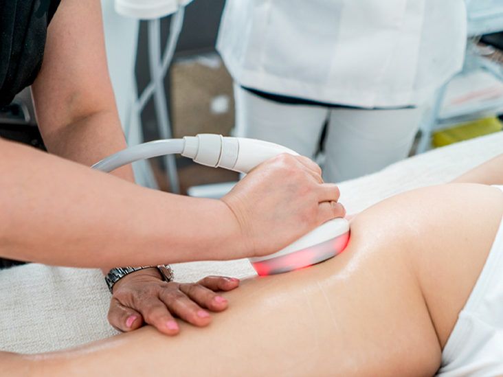 How Is Laser Lipolysis Treatment Performed Step-by-Step