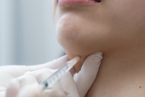 How Many Kybella Sessions Needed