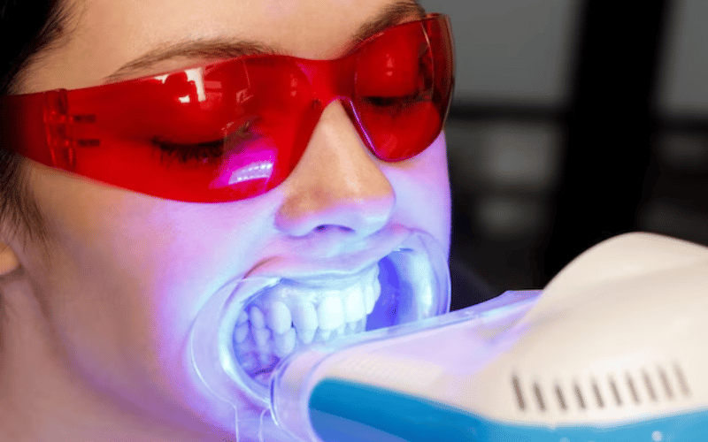 How Often Should You Get Zoom Teeth Whitening?