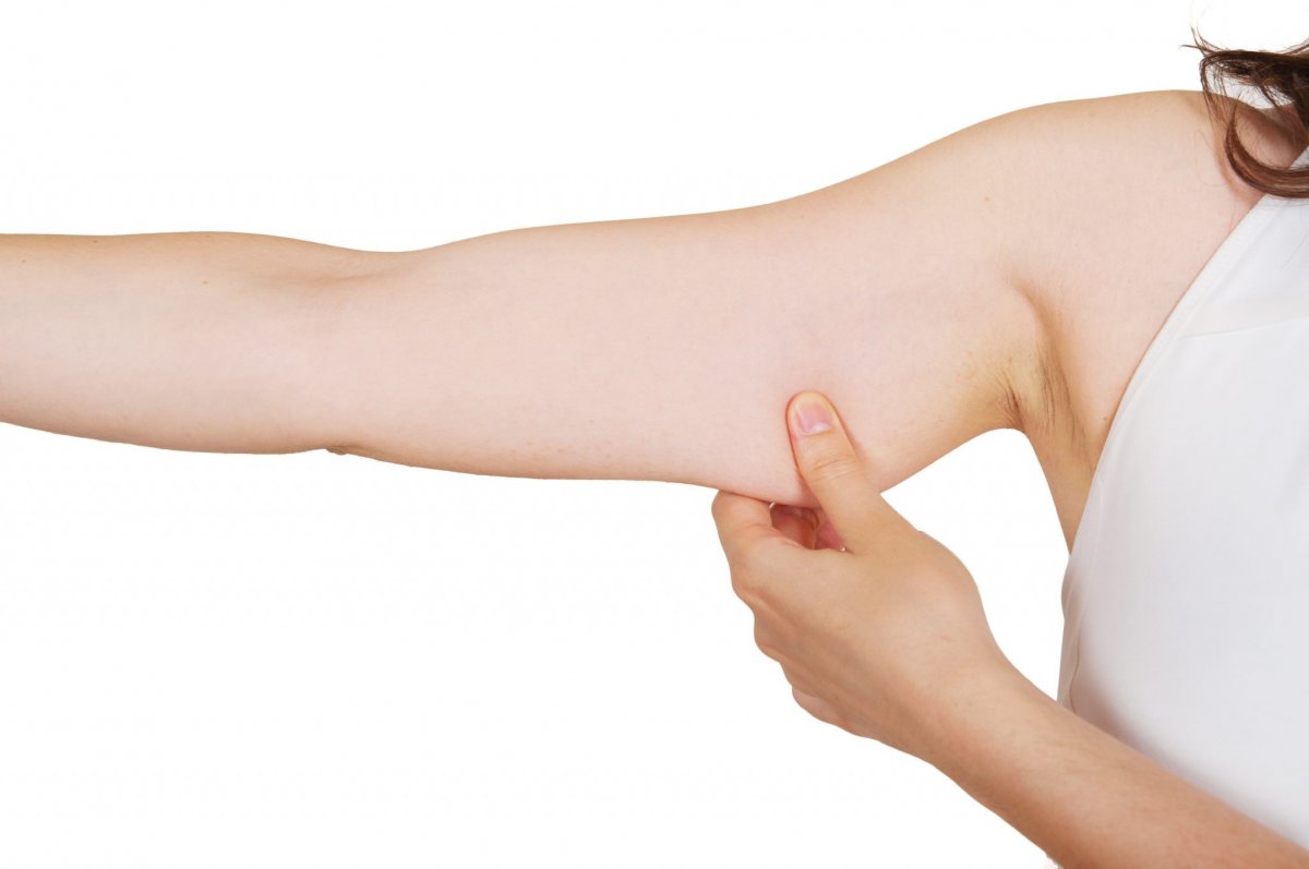 How Scarring Is Managed After an Arm Lift Procedure