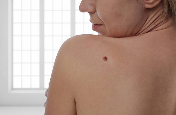 How to Prepare for Mole Removal Treatment