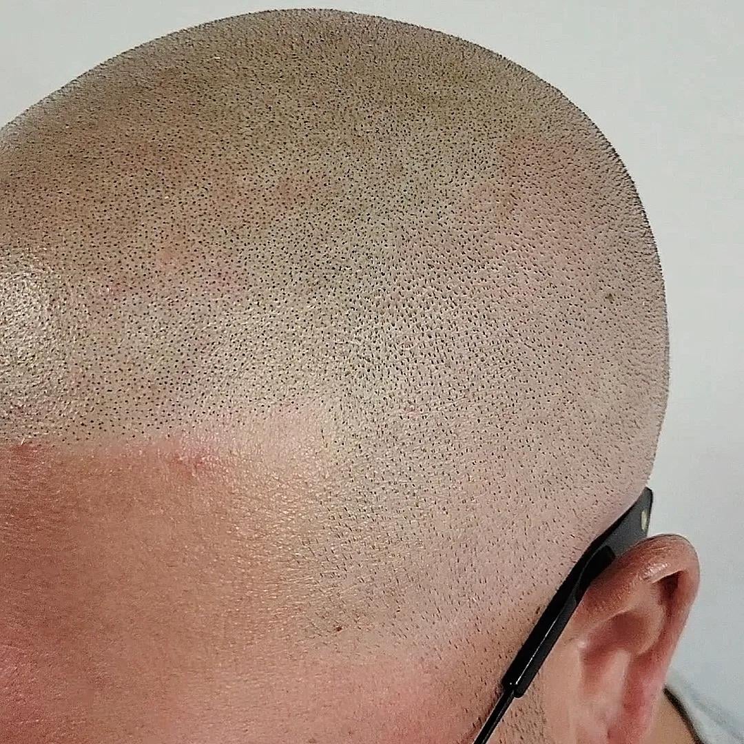 How to Prepare for Scalp Micropigmentation