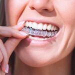 invisalign Paisley