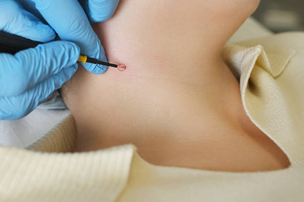Is Mole Removal  Permanent