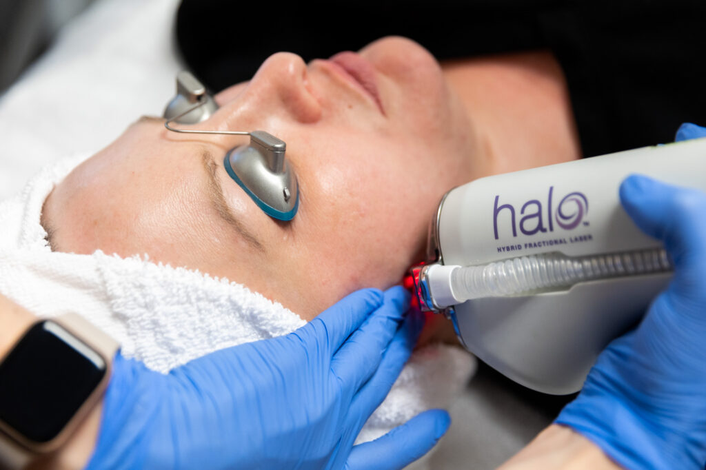 Safe and Effective Skin Resurfacing with Halo