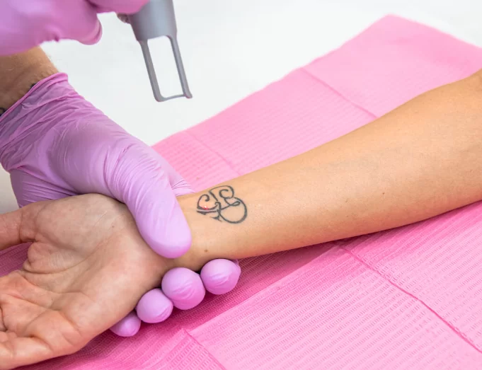 Undo Your Tattoo
