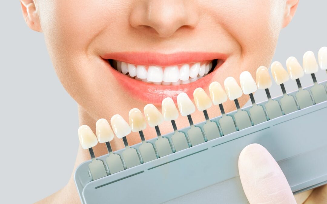 E-max Veneers in Dubai: Trends and Patient Experiences
