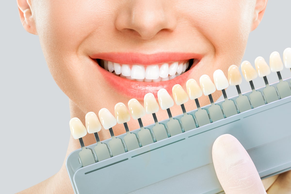 What Makes E-max Veneers Different From Other Cosmetic Dental Options