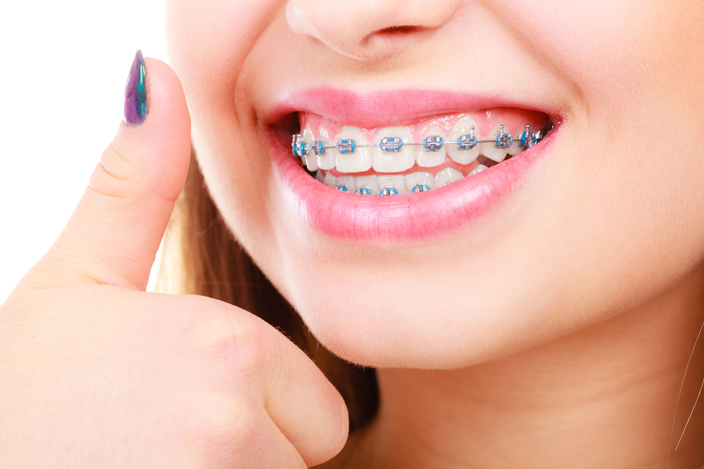 What Orthodontists Recommend for Fast, Effective Results