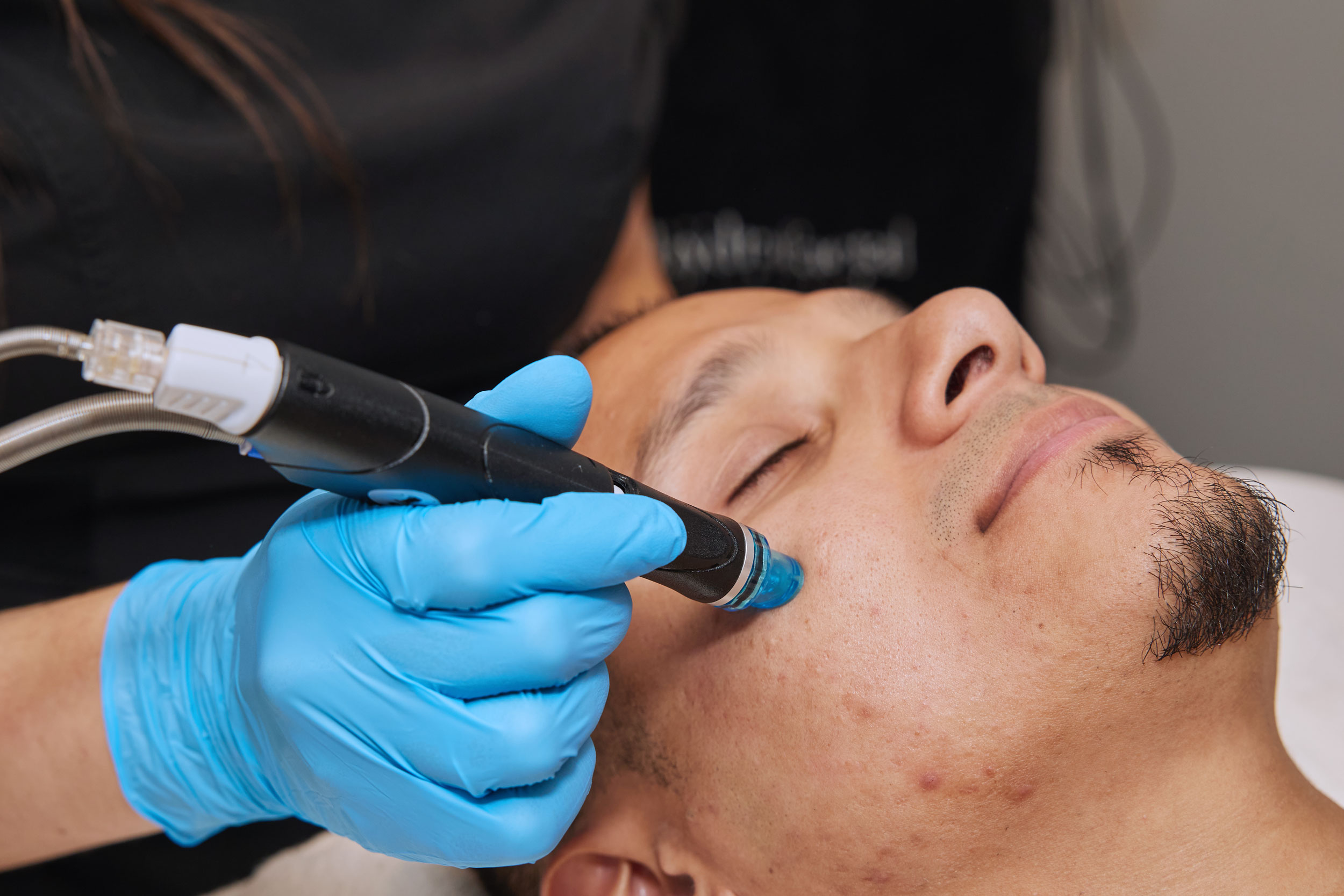 Why the Modern Man Swears by Monthly HydraFacials