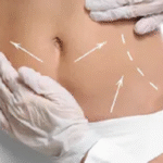 Liposuction Surgery in Dubai