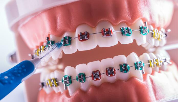 Dental Braces and Allergies: What Materials Are Safe?