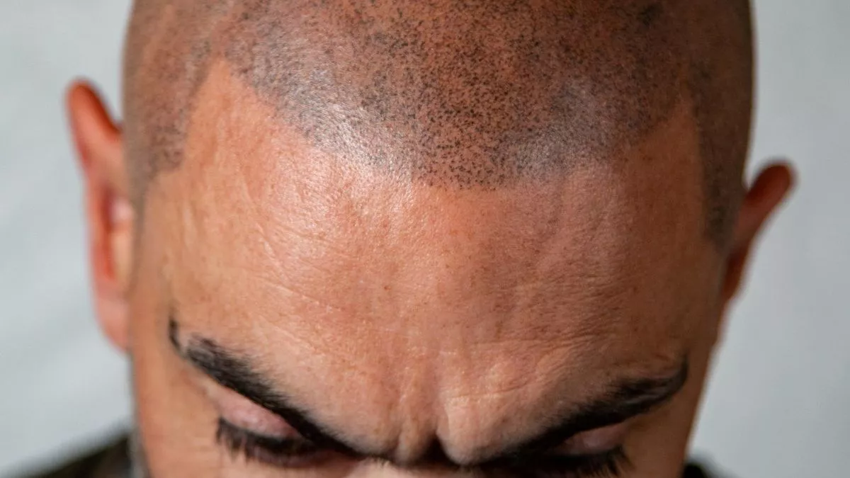 Does Hair Replacement Work for Receding Hair
