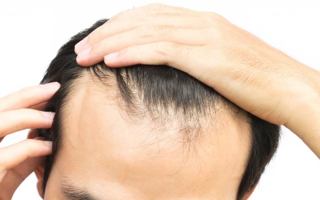 Does Scalp Micropigmentation Fade Over Time?