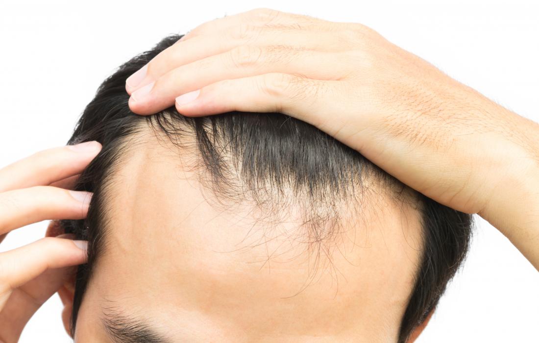 Does Scalp Micropigmentation Fade Over Time