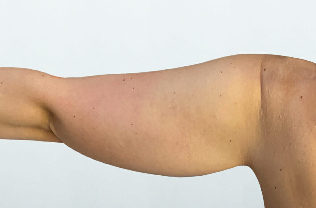 Explore Minimally Invasive Arm Lift Options