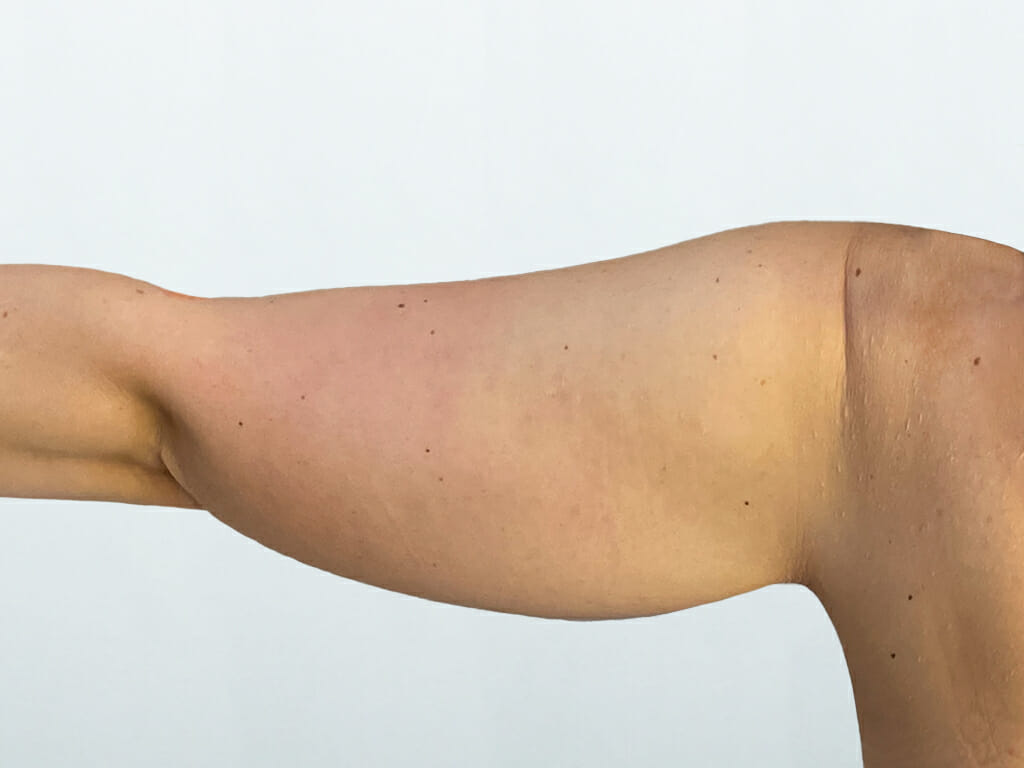 Explore Minimally Invasive Arm Lift Options