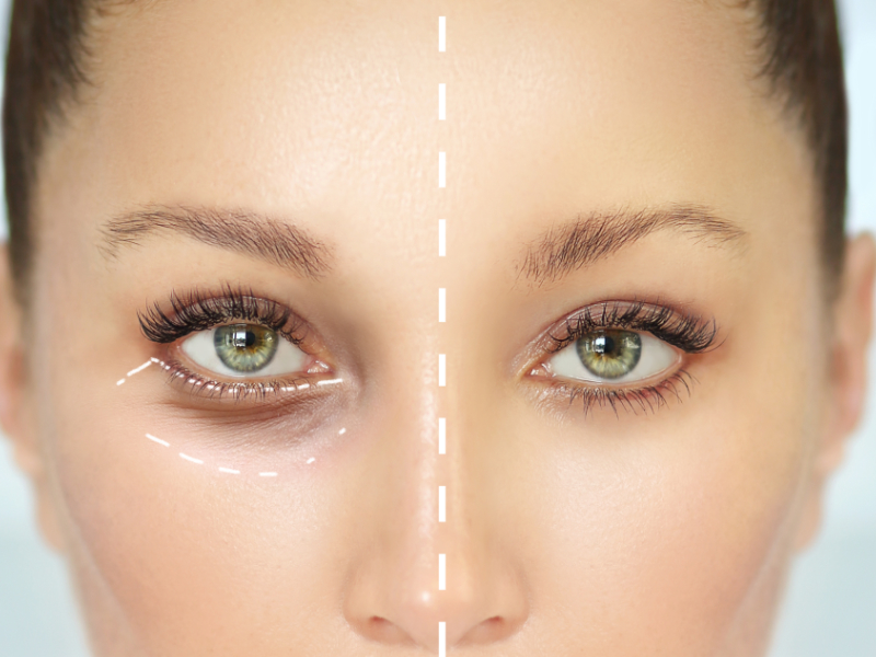 Eyelid Rejuvenation Surgery for a Bright, Alert Look