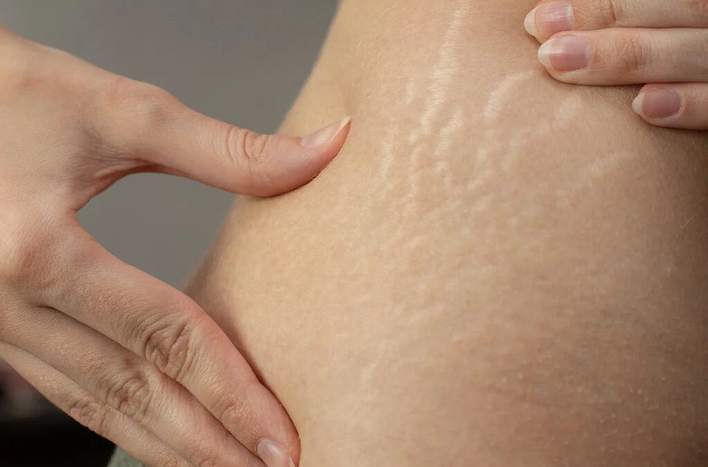 Can I Remove Stretch Marks from Weightlifting?