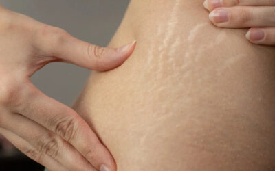 Can I Remove Stretch Marks from Weightlifting?