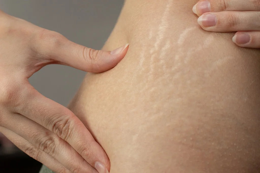 Fade stretch marks quickly
