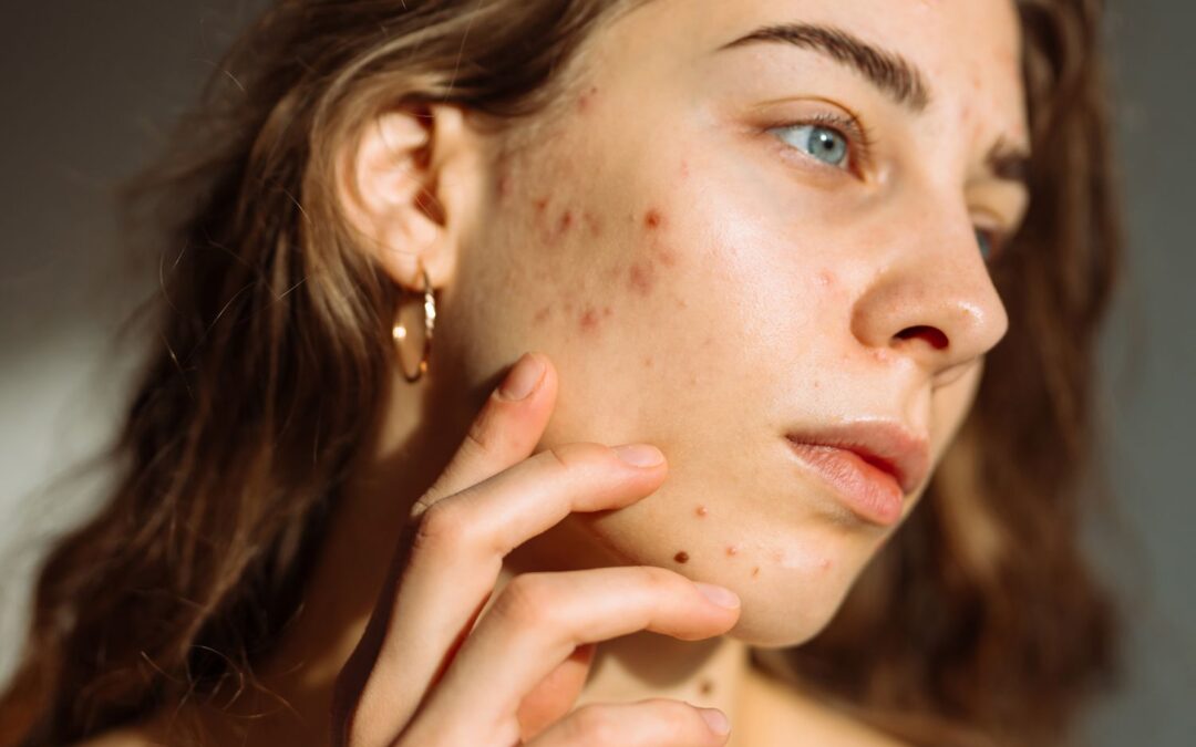 Do Silicone Sheets Work on Old Acne Scars?