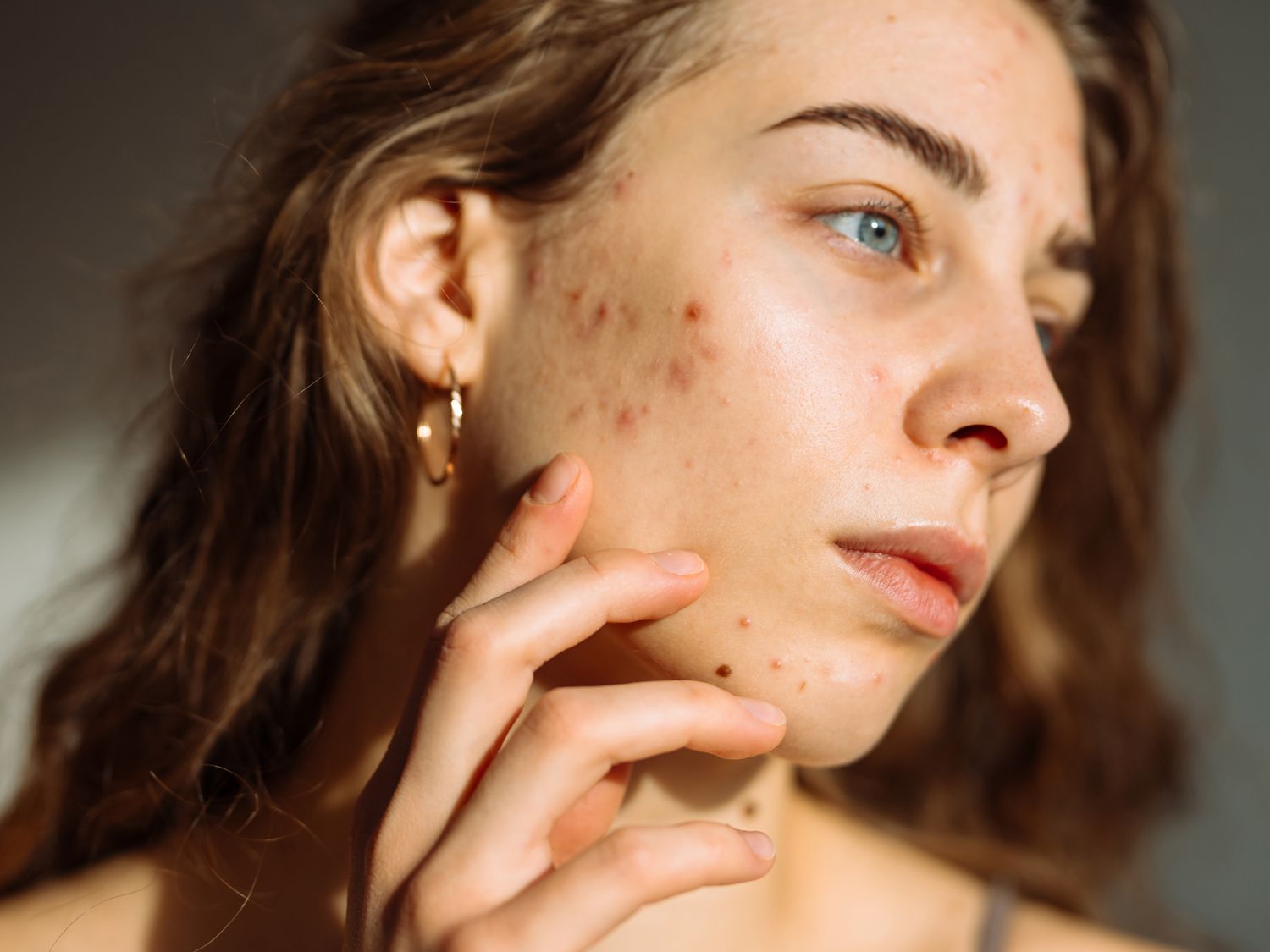 Goodbye acne marks