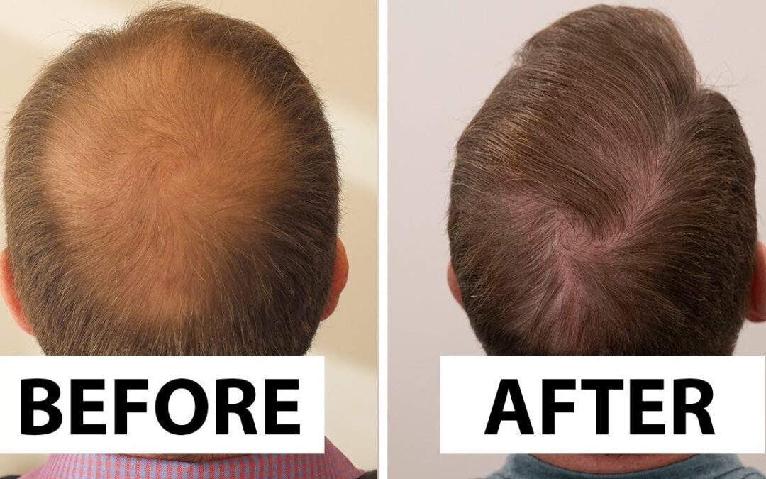 What to Expect on the Day of Your 1 Dirham Hair Transplant?
