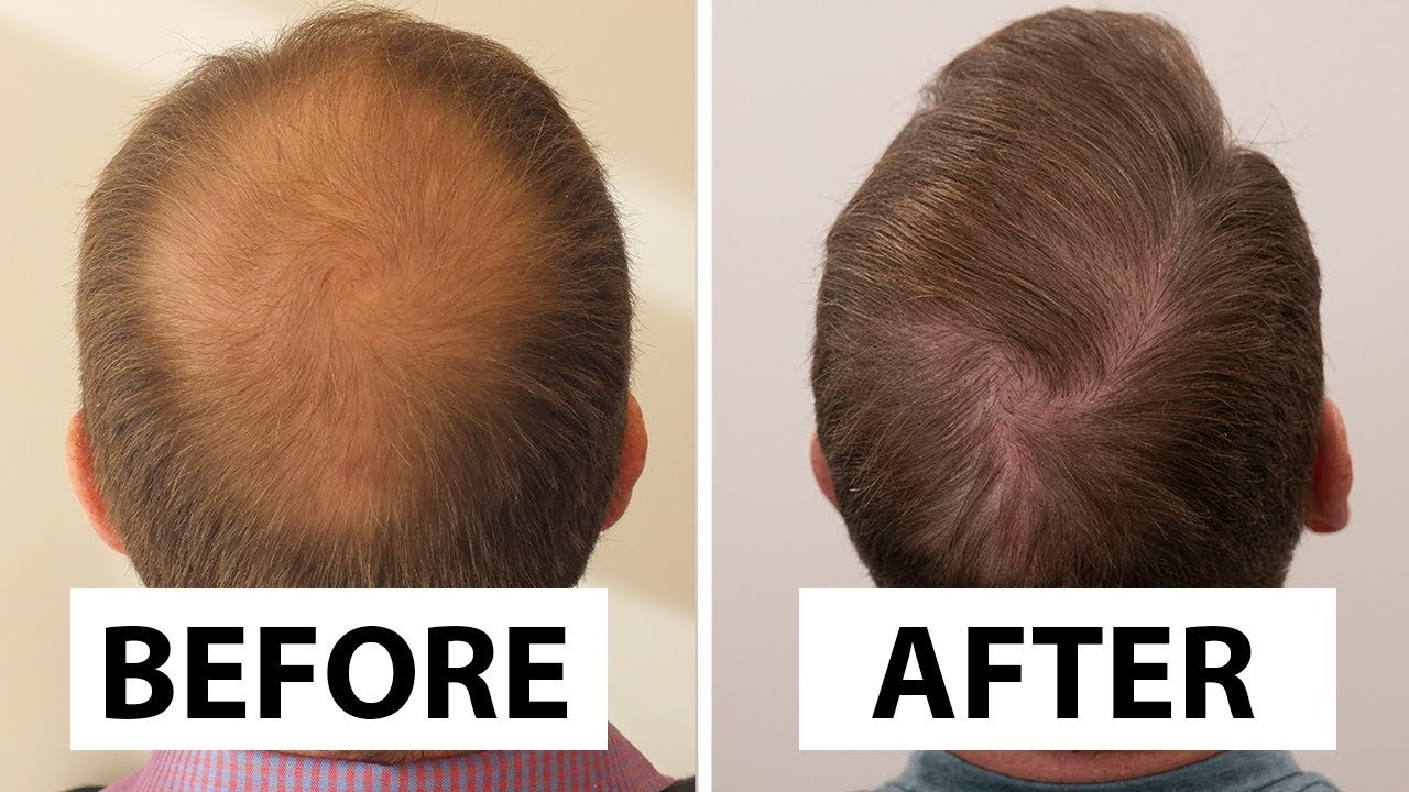 Hair transplant deal 1 dirham.