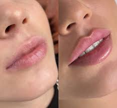 What Not to Do Before Russian Lip Fillers?