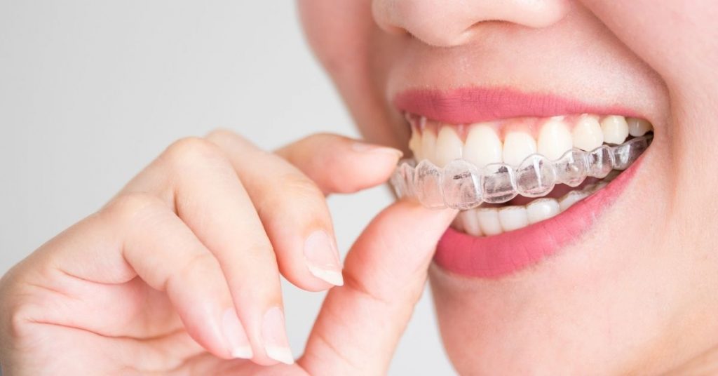 How Long Does Aligners Treatment Take? Factors That Affect Your Timeline