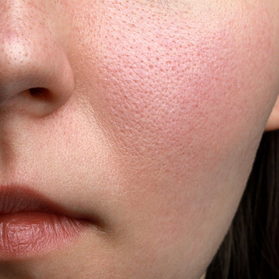 How to Close Pores Permanently With the Help of Chemical Peels