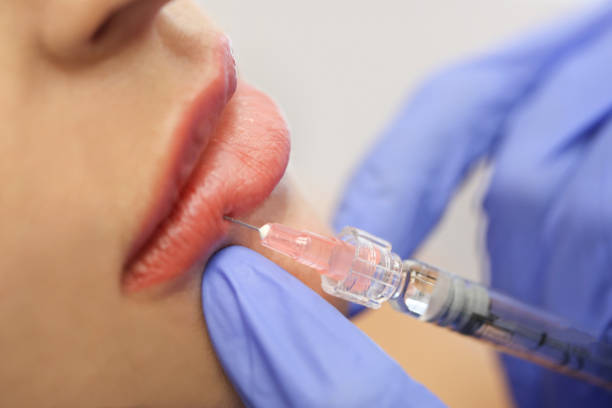 How to Prepare for Lip Fillers ?
