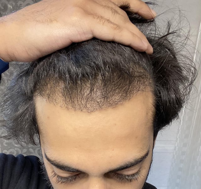 How to Prepare for Your FUE Hair Transplant Session